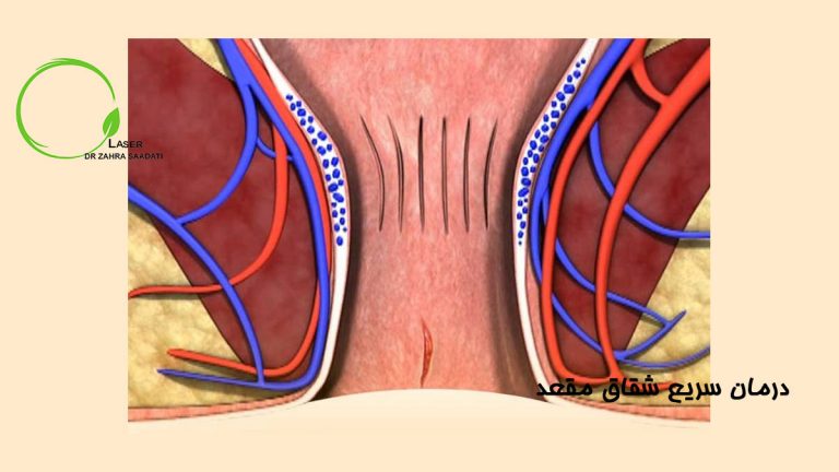 درمان سریع شقاق مقعد