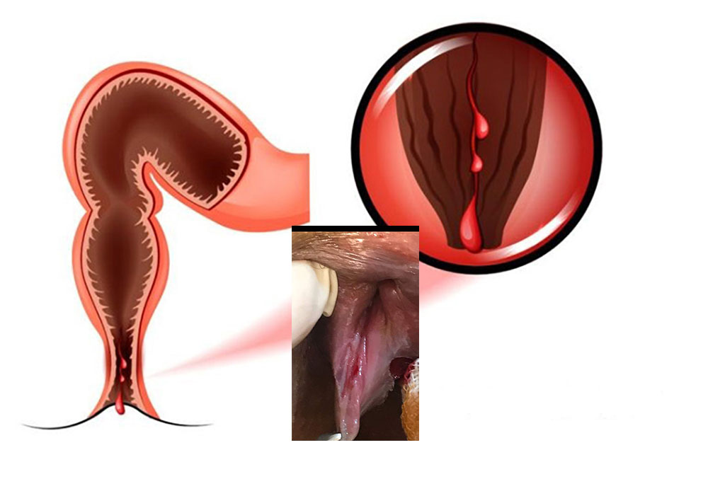 Anatomy of anal fissure operation