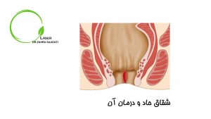 شقاق حاد و درمان