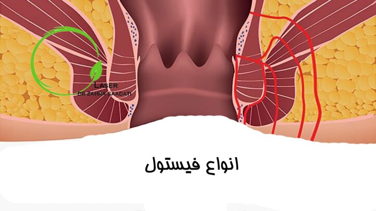 انواع فیستول