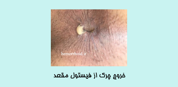 فیستول مقعد قبل از عمل جراحی