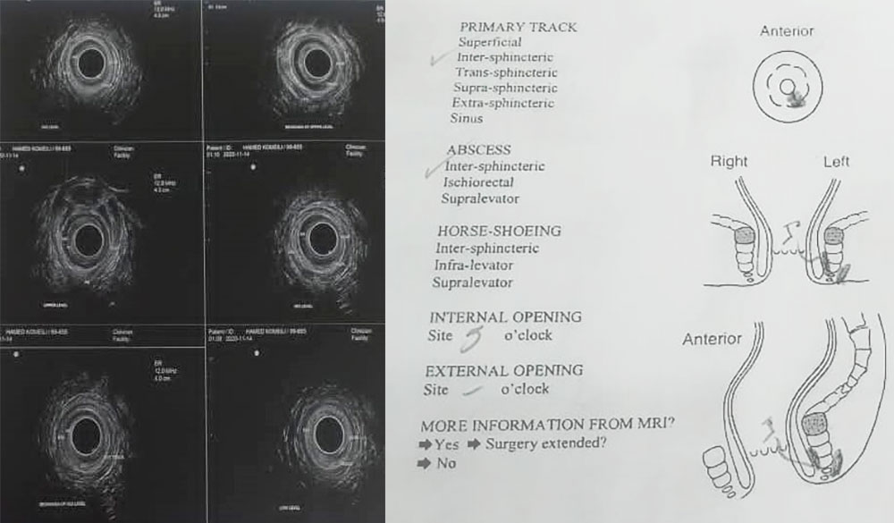 MRI report of anal fistule
