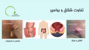 تفاوت شقاق و بواسیر