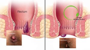 hemorrhoid or piles