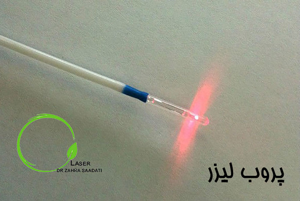 پروب لیزر برای درمان فیستول مقعدی