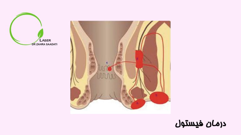 درمان فیستول