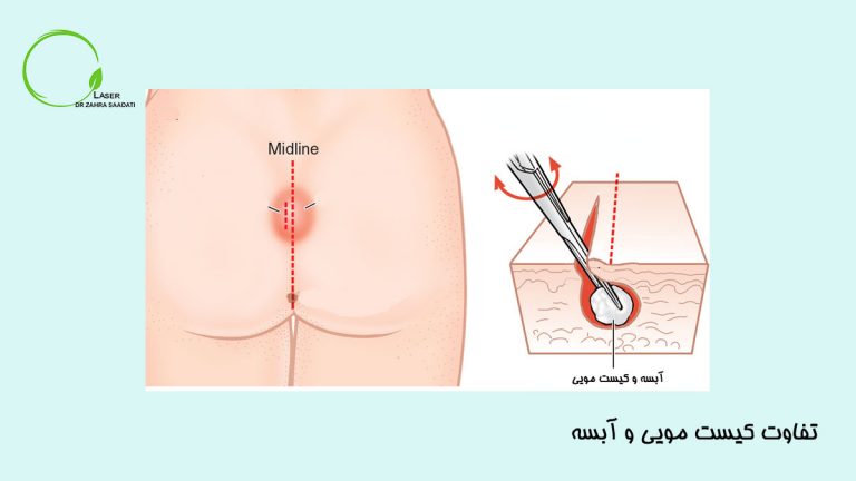 تفاوت کیست مویی و آبسه چیست