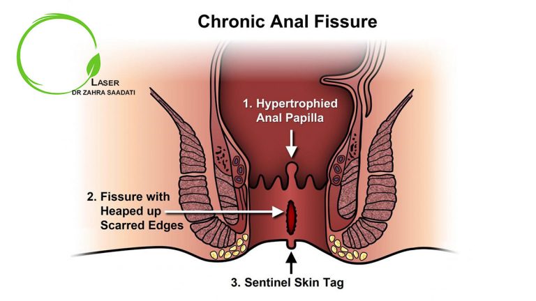 شقاق مقعدی مزمن