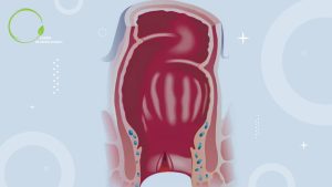 عوارض جراحی شقاق مقعدی