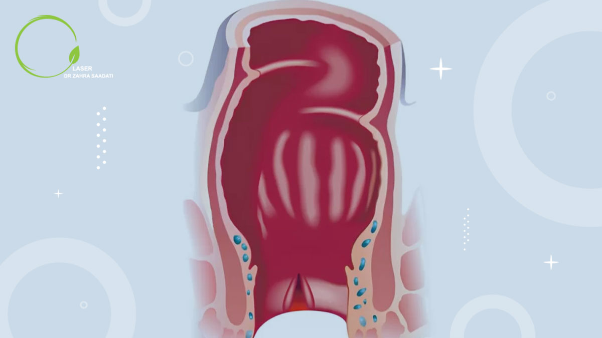 عوارض جراحی شقاق مقعدی