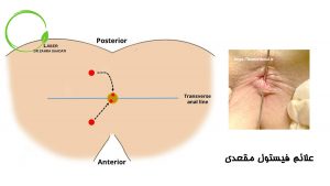 علائم فیستول مقعدی