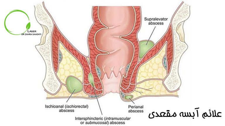 علائم آبسه مقعدی