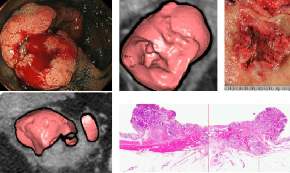 سرطان مقعد آناتومی و تصاویر