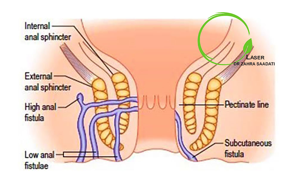 علائم فیستول مقعدی