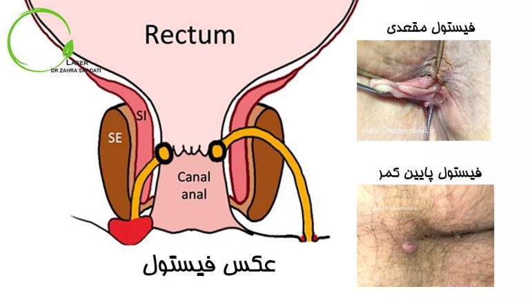 عکس فیستول