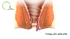 علائم بواسیر داخلی