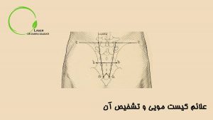 علائم کیست مویی و تشخیص