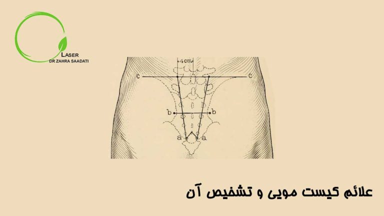 علائم کیست مویی و تشخیص