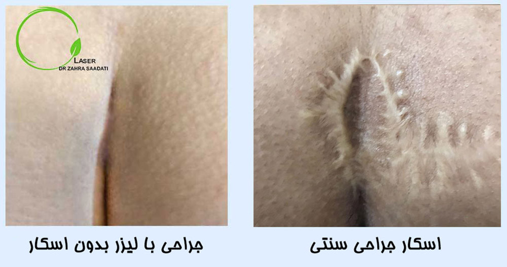 عکس کیست مویی که سمت چپ با لیزر و بدو ن اسکار جراحی شده است و سمت راست که بدون لیزر و با اسکار جراحی شده