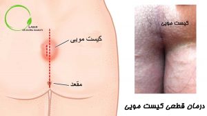 درمان قطعی کیست مویی