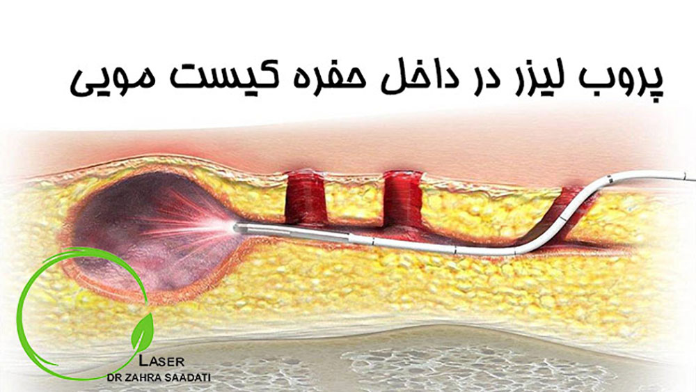 لیزر درمانی کیست مویی با پروب لیزر در داخل حفره کیست مویی