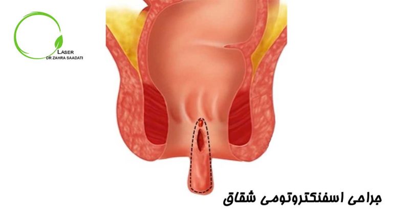 جراحی اسفنکتروتومی شقاق