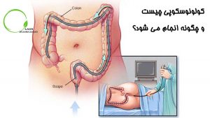 کولونوسکوپی چیست و چگونه انجام می شود