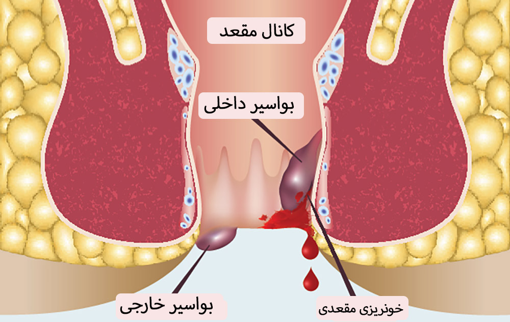 شماتیک بواسیر داخلی و خارجی همراه با خونریزی مقعدی در کانال مقعد