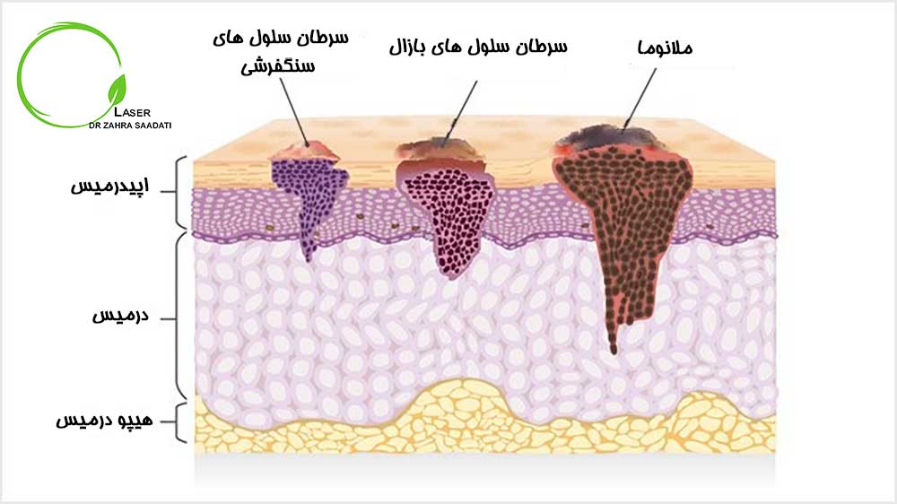 تشخیص سرطان کیست مویی