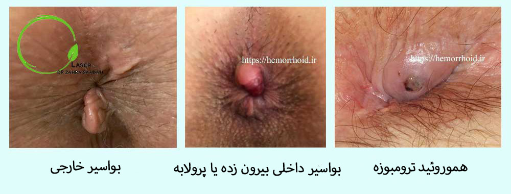 تصویر سمت چپ بواسیر خارجی عکس وسط بواسیر داخلی بیرون زده و سمت راست هموروئید ترومبوزه