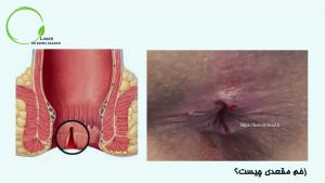 زخم مقعدی چیست