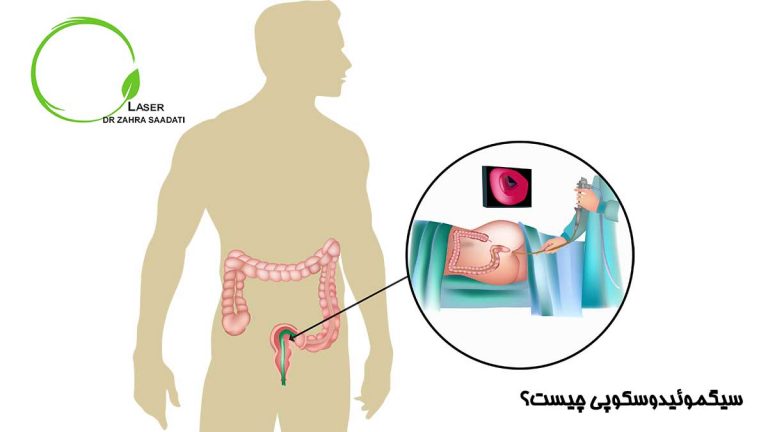 سیگموئیدوسکوپی چیست