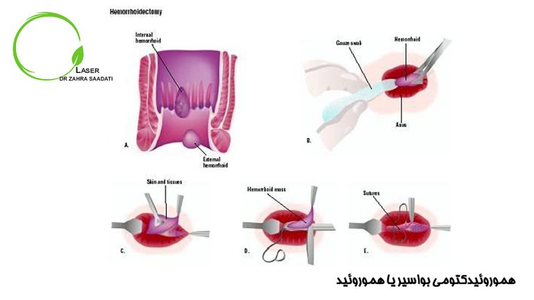 هموروئیدکتومی برای هموروئید یا بواسیر