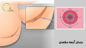 درمان آبسه مقعدی