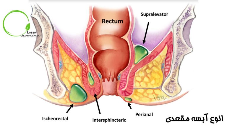 انواع آبسه مقعدی چیست