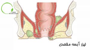 لیزر آبسه مقعدی