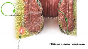 لیزر filac فیستول مقعدی