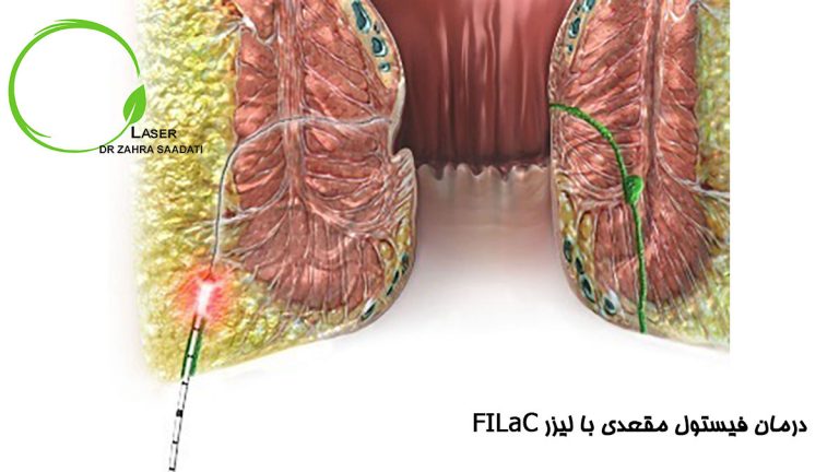 لیزر filac فیستول مقعدی