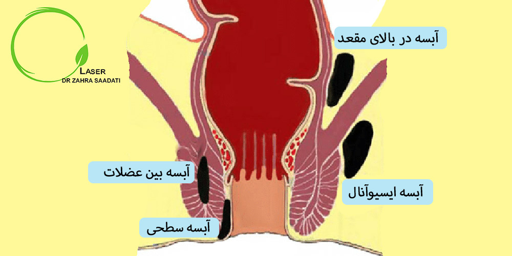 شماتیک دسته بندی انواع آبسه مقعدی سطحی، بین عضلات، بالای مقعد و ایسیوآنال