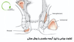 تفاوت لیزر آبسه مقعدی با عمل جراحی سنتی