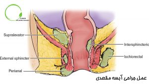 عمل جراحی آبسه مقعدی