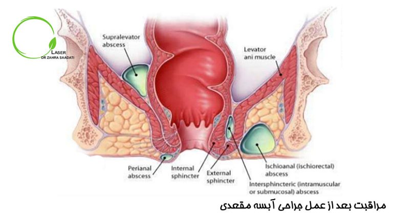 مراقبت بعد از عمل جراحی آبسه مقعدی