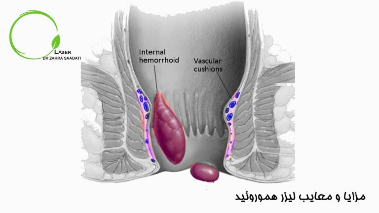 مزایا و معایب لیزر هموروئید