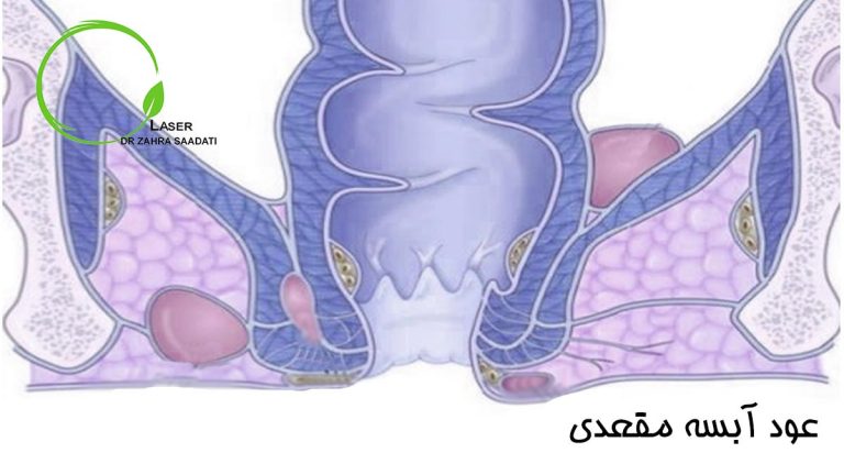 عود آبسه مقعدی