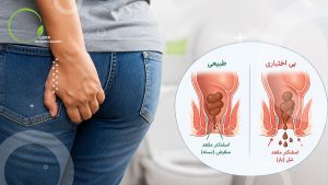بی اختیاری مدفوع و گاز