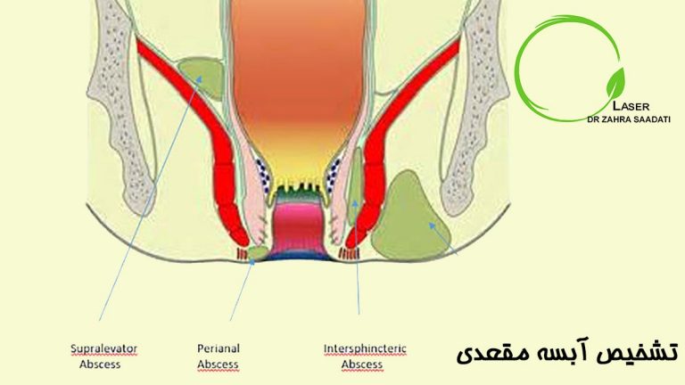 تشخیص آبسه مقعدی