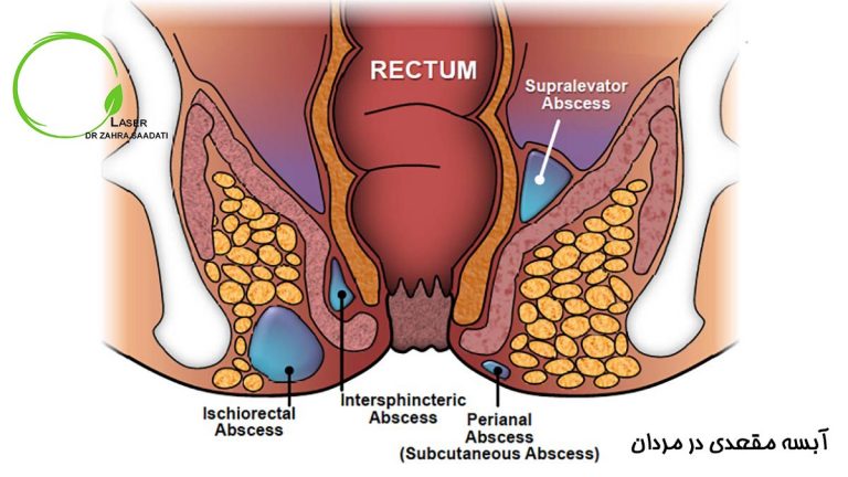 آبسه مقعدی در مردان