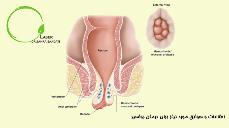 اطلاعات و سوابق مورد نیاز برای درمان بواسیر