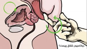 دیلاتاسیون شقاق مقعد چیست