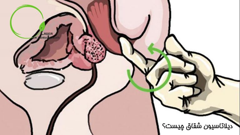 دیلاتاسیون شقاق مقعد چیست